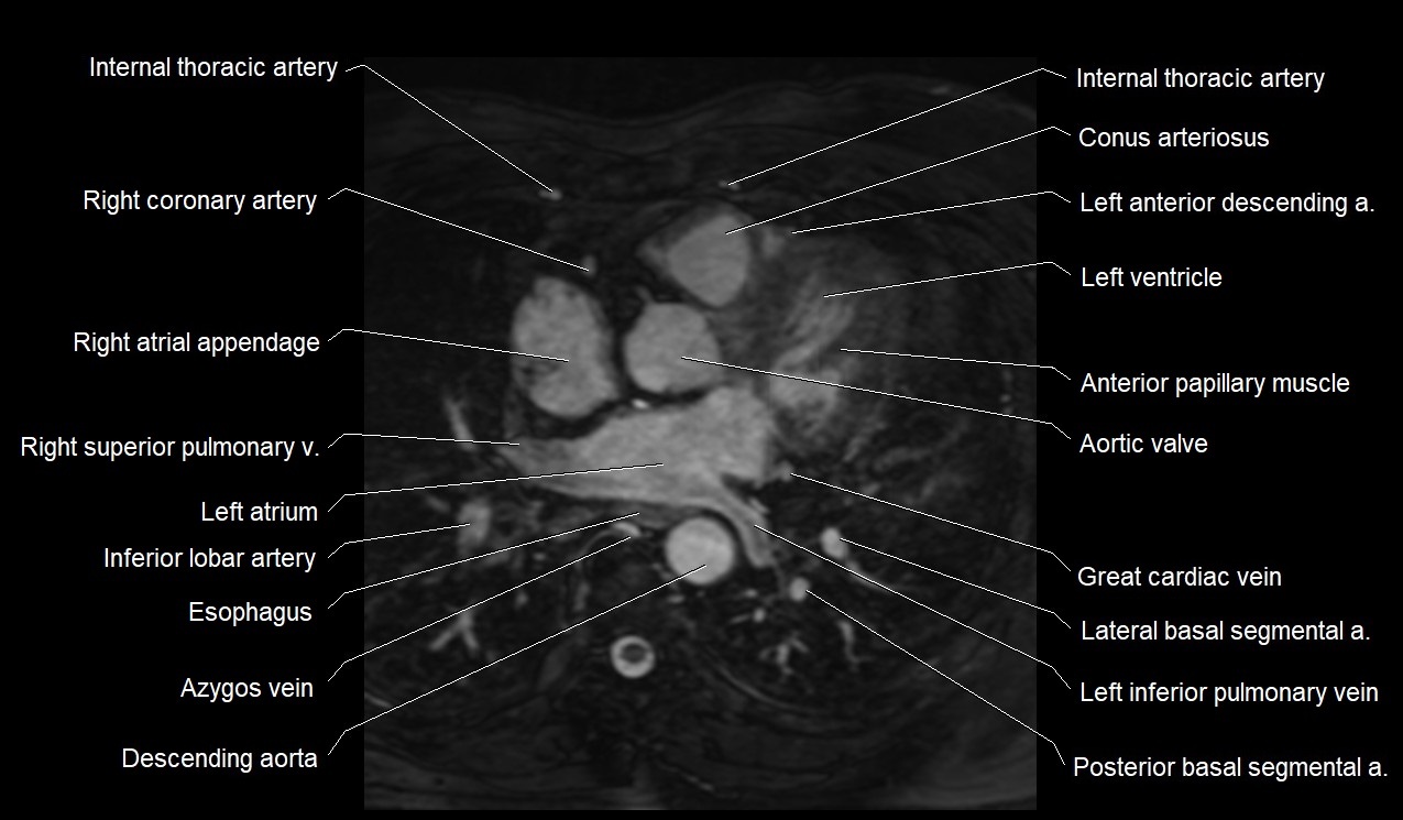 MRI heart coronary arteries and coronary veins anatomy axial image 19.jpg
